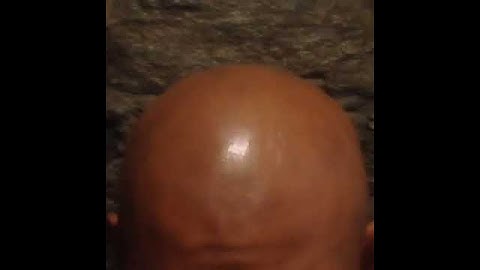 3D Scalp Micropigmentation: Dr. w/ Alopecia Flies to NYCw/ Chris