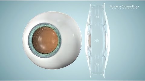 When EVO ICL Is Indicated for Low Myopes