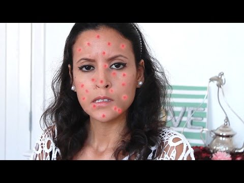 أسرع الطرق للتخلص من الحبوب | إسوارة أسرع الطرق للتخلص من الحبوب | إسوارة