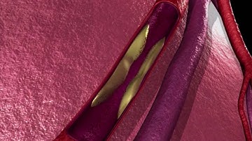 Coronary Angioplasty Procedure EXPLAINED! Medical Coding Reference!