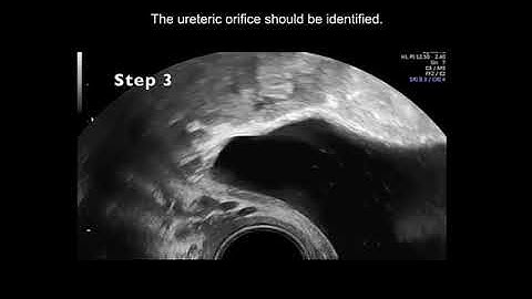 UOG video clip: how to assess the ureters during pelvic ultrasound