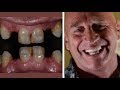 Honest review costa rica dental implants  dental work