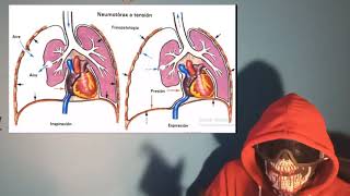 Explicación y A.P.H  de Neumotórax a Tensión, abierto, simple, y Hemotórax