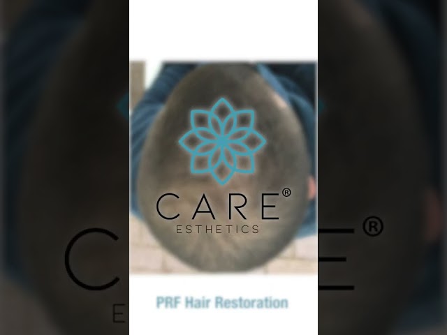 PRF Hair Restoration by CARE Esthetics class=