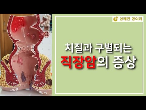 치질과 구별되는 직장암 증상