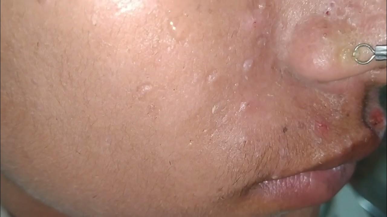 latest video sac dep spa 2023 blackheads removal sac dep spa 2023