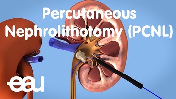 Removal of kidney stones: PCNL
