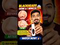 This Blackhead Vacuum Removes Pores Dirt in Seconds! 😳| #blackheadremover #porescleaning #skincare