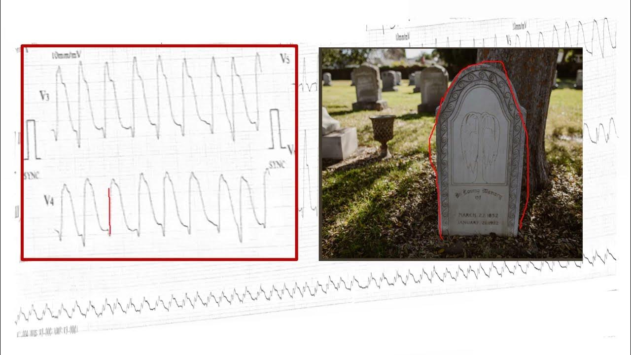 ecg-i-myocardial-infarction-i-tombstone-pattern-i-cardiac-emergency-i