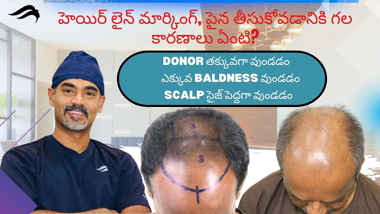 Hair Transplant In Hyderabad Best Clinic Results Surgeon Of Hair hair-transplant-in-hyderabad-best-clinic-results-surgeon-of-hair