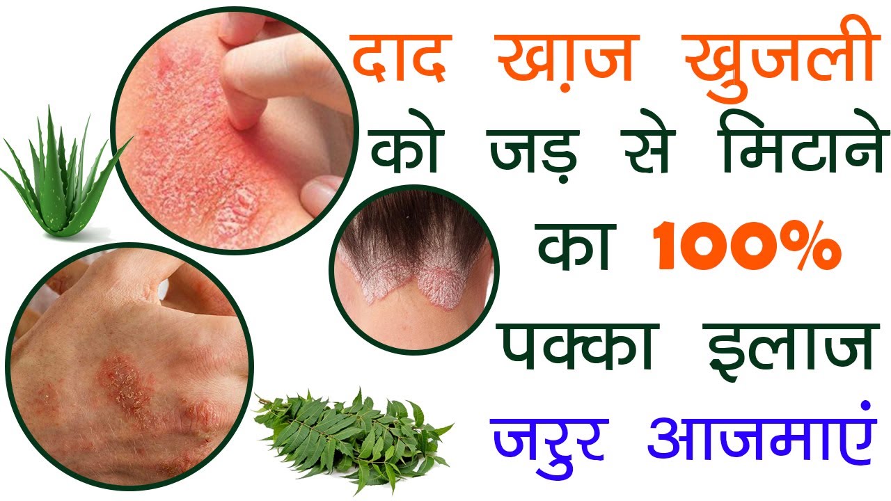 60 साल पुराने दाद खाज खुजली की 60 सेकंड में छुट्टी कर देगा,fungal,daad
