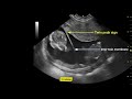 Twin Pregnancy on Ultrasound