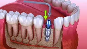AMAZING Dental Implant Process 3d Animation