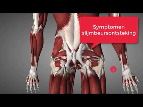 Video: Coxartrose Van Het Heupgewricht - Oorzaken, Symptomen, 2 En 3 Graden, Behandeling. Gymnastiek En Massage