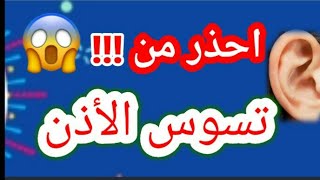 #تسوس الأذن _ الأعراض_ الوقاية