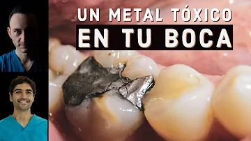 ¿Por qué los dentistas utilizan empastes negros?