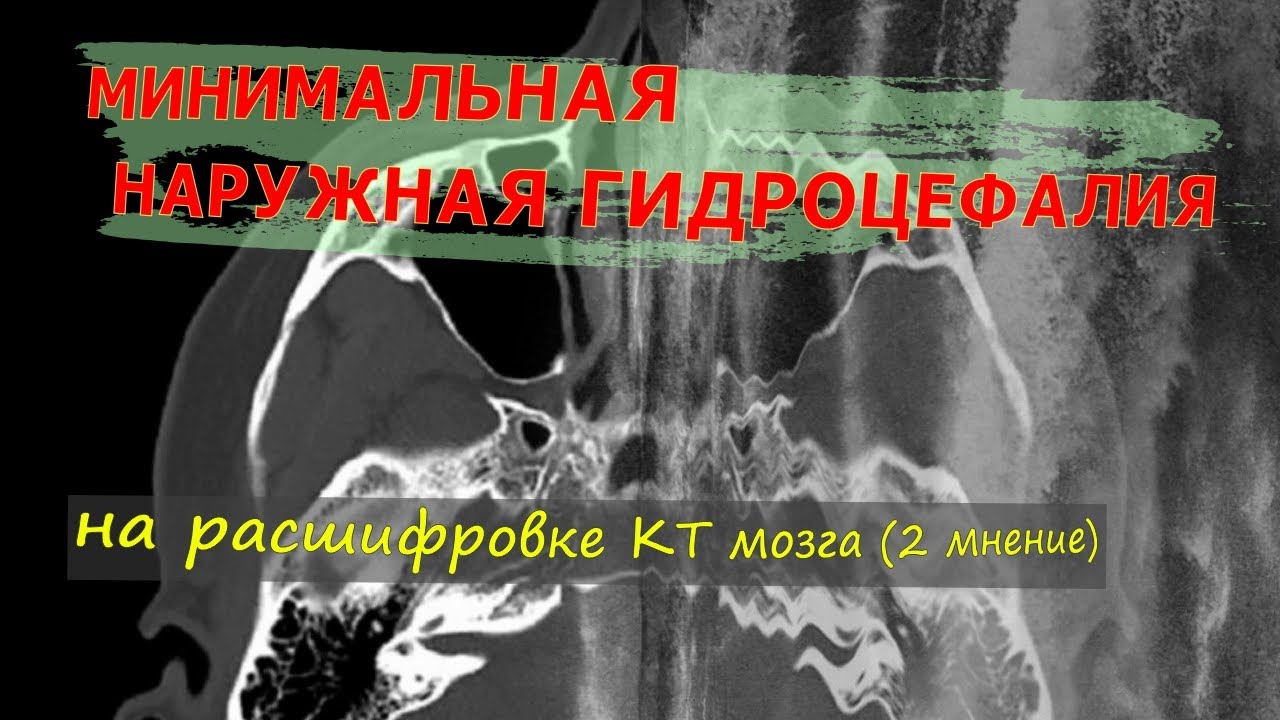 Минимальная НАРУЖНАЯ ГИДРОЦЕФАЛИЯ на КТ расшифровке головного мозга ...