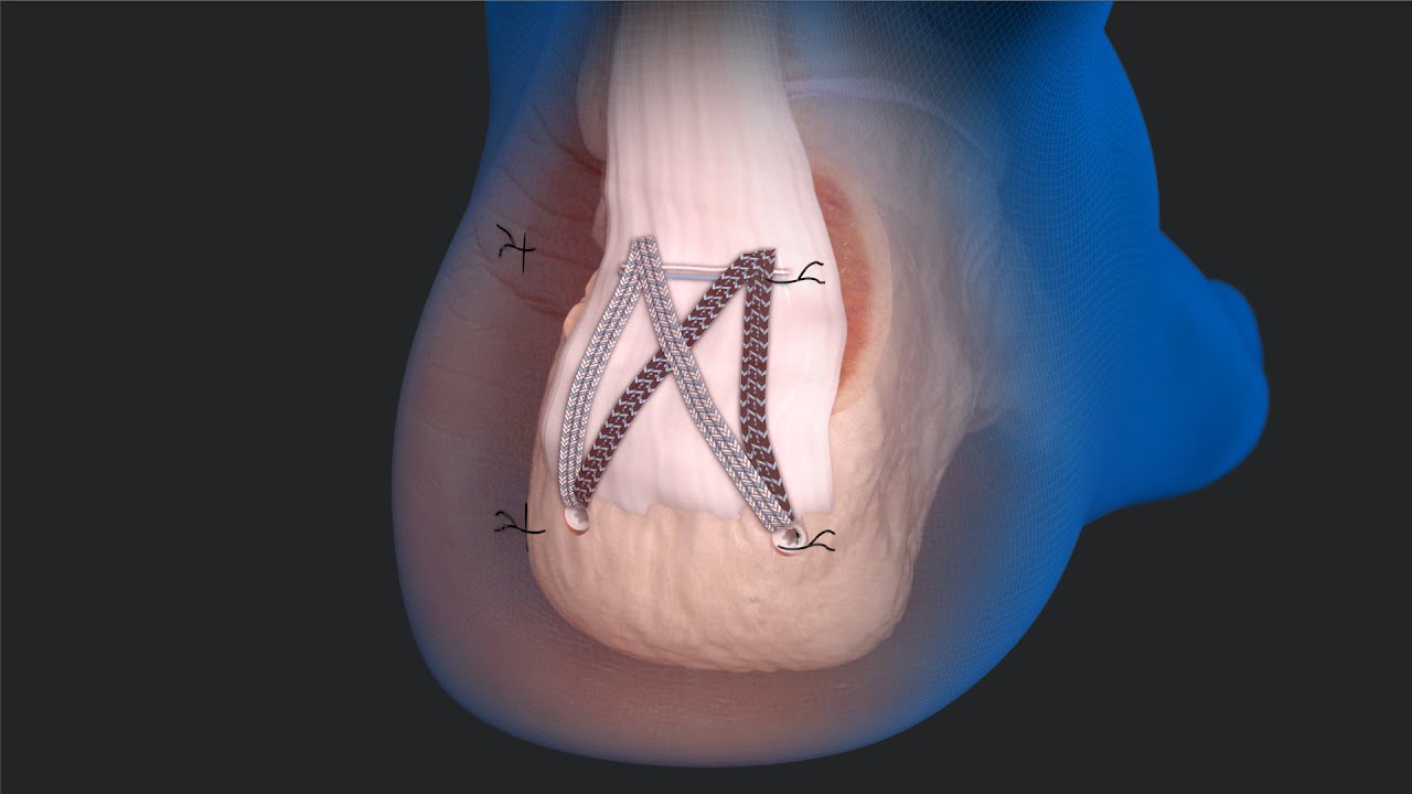 MIS FiberTak® Achilles SpeedBridge™ Repair System Animation - YouTube