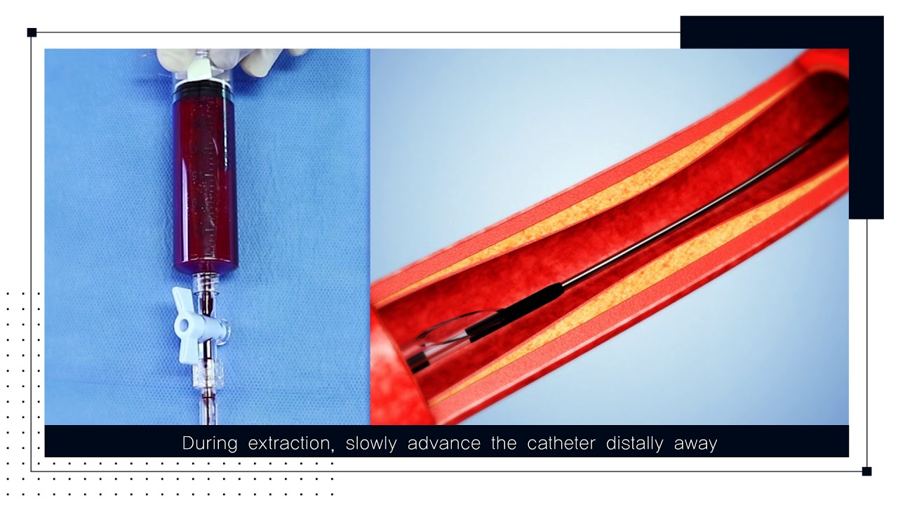 Cath Extractor GENOSS Extractor Aspiration Catheter - YouTube