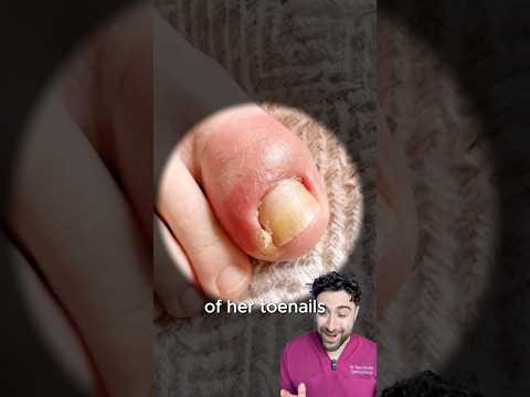 How to treat an Ingrown Toenail at Home