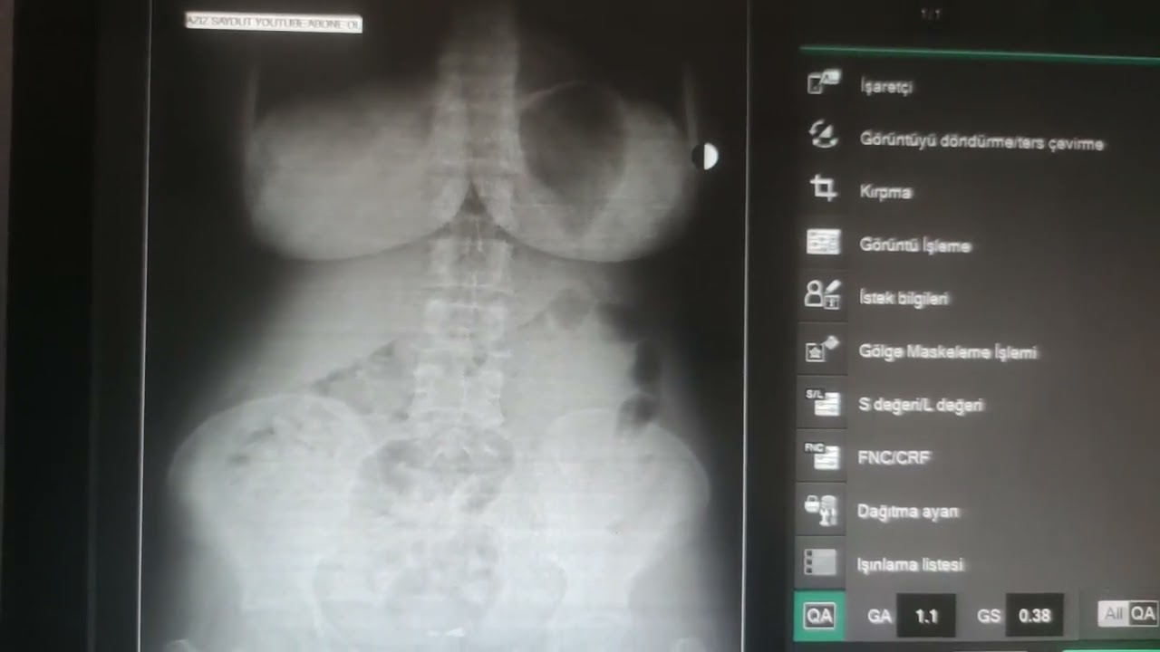 Radyolojik Anatomi Ayakta Direk Batın Grafisi, Anatomik anlatım