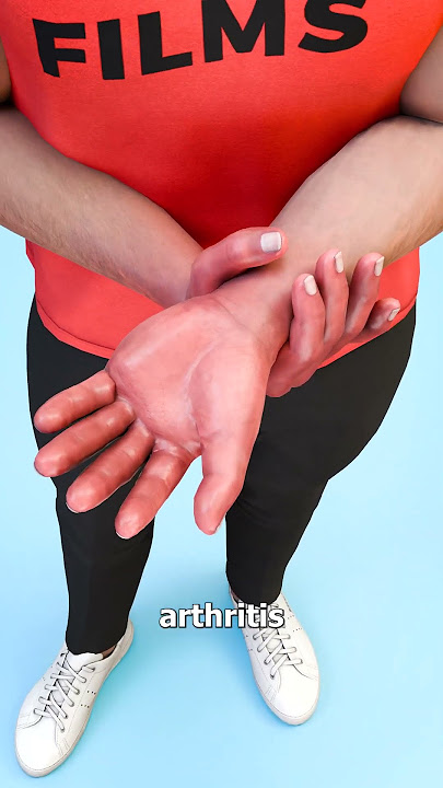 How Bee Sting Therapy Works 😮