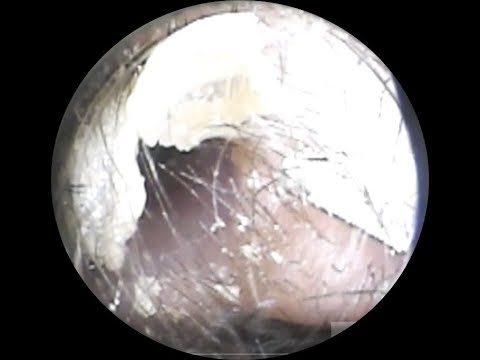 Vol.144【耳掃除】モンゴル人のお耳～eariss