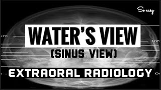 WATER'S VIEW II REFERRED AS "SINUS VIEW" II EXTRAORAL RADIOGRAPHY
