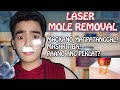 Mole Laser Removal | Magkano magpatanggal ng nunal| Masakit ba?