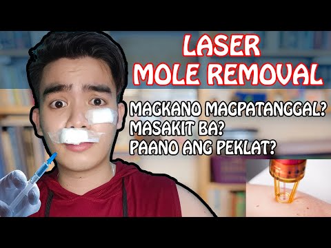 Mole Laser Removal | Magkano magpatanggal ng nunal| Masakit ba?