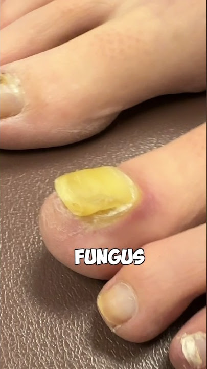 How to Remove Toenail Fungus 😷🩺🩻