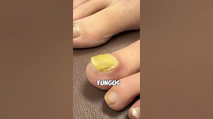 How to Remove Toenail Fungus 😷🩺🩻