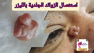 استئصال الزوائد الجلدية بالليزر  #الزوائد_الجلدية #علاج_الزوائد_الجلدية_بالليزر