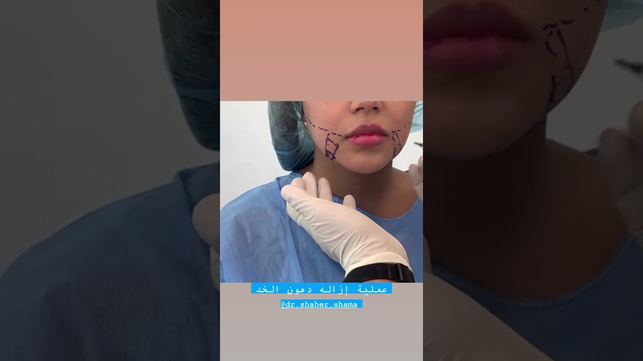 عملية ازالة دهون الخد. #بوتكس #فيلر #تجميل #botox #fillers #beforeandafter #الكويت #كويت #خليجيات