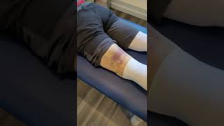 Hématome Après Opération De Ligament Croisé É É É