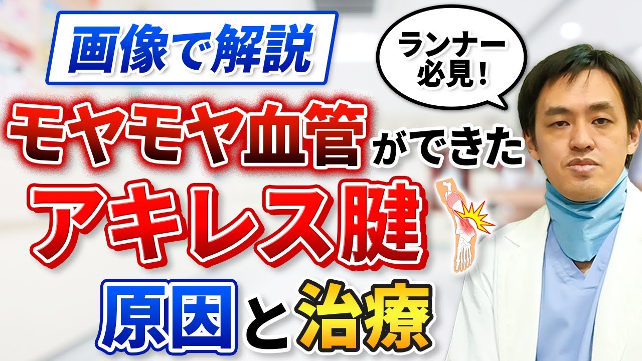 モヤモヤ血管ができたアキレス腱 原因と治療を医師が解説