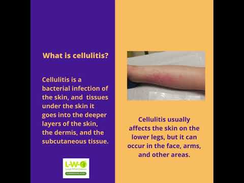 Cellulitis in Children