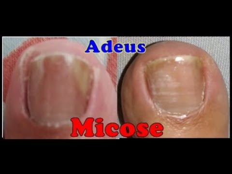 COMO ACABAR COM A MICOSE DE UNHA ..RECEITA CASEIRA - YouTube