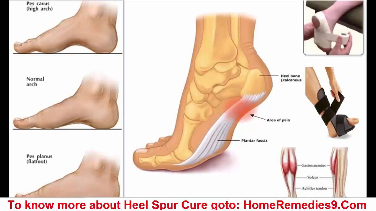 Heel Spur Cure - Latest Cure For Heel 