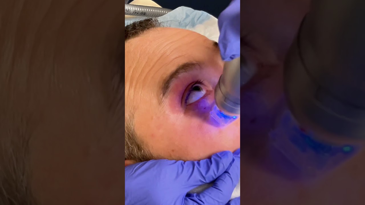 Treat Eye Bags Without Getting a Blepharoplasty