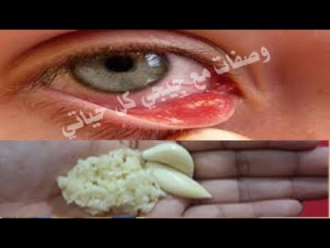 حبة ثوم واحده فقط للقضاء على ضعف النظر نهائيا معجزة تحسين البصر في اقل من شهر لقوة نظر 6 6 مع جيجي