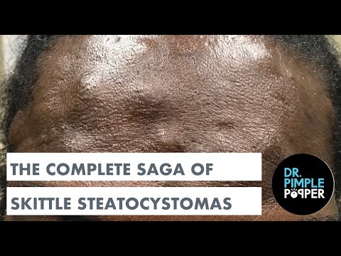 Dr. Pimple Popper Presents: The Complete Saga of Skittle Steatocystomas - Dr. Pimple Popper Presents: The Complete Saga of Skittle Steatocystomas