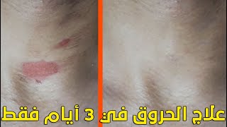 علاج الحروق وازالة اثارها - طريقة إزالة آثار الحروق والندب على الجلد Burn Treatment - موسوعة بوكليت