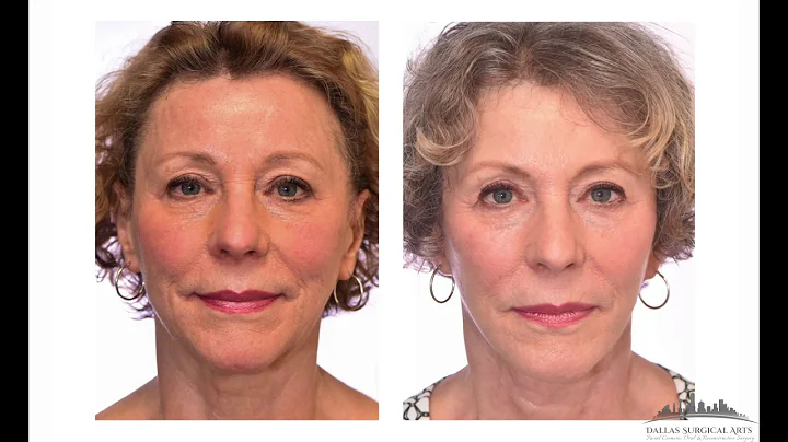 Before and After a Facelift by Dr. Randy Sanovich