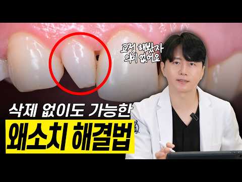 Showing you cases of small lateral incisors (peg teeth) perfect for no-prep veneers