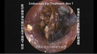 Regular cleaning of diffuse external auditory canal cholesteatoma 20241107