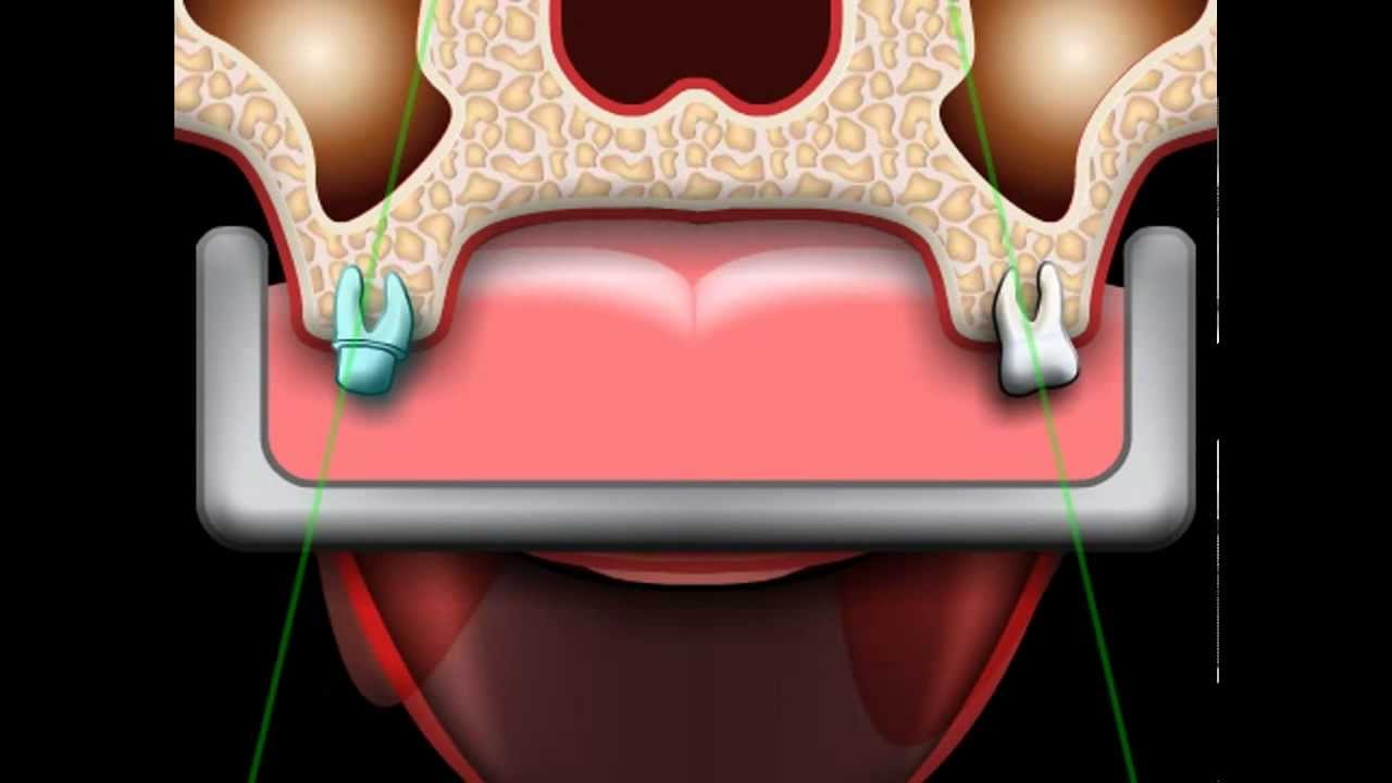 Errore di Impronta dentale
