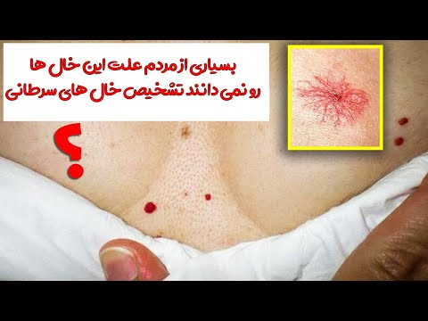 بسیاری از مردم علت این خال هارو نمی دانند