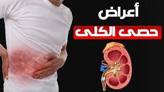 أعراض حصى الكلى وطرق العلاج