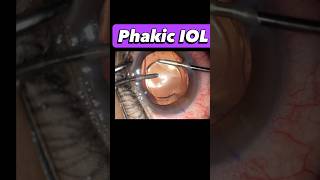 High Myopia? Thin Cornea? We have a solution !